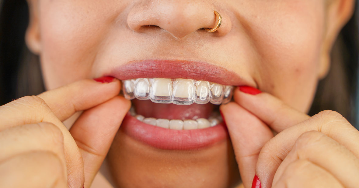 traitement Invisalign